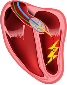 TAVI-Electroducer